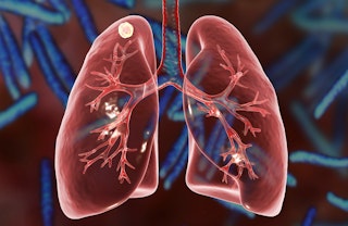 Tuberculosis in the Healthcare Environment