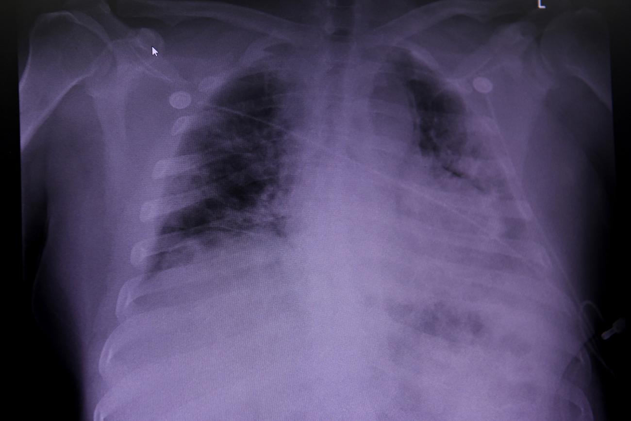 The photo shows a chest X-ray with portions of the lungs appearing very dark.