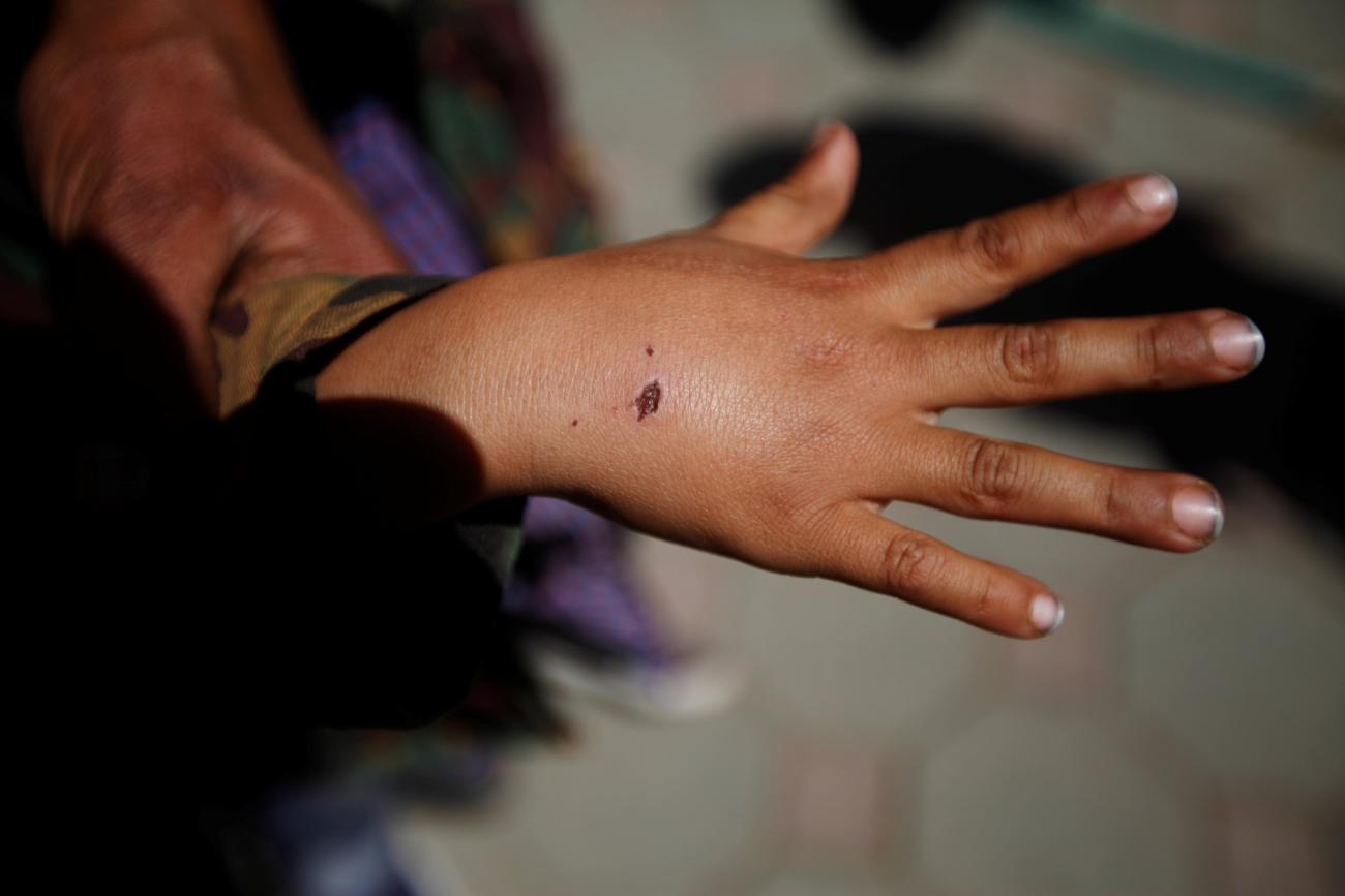 A boy shows a wound he sustained after a stray dog attacked him, at a rabies clinic in Sanaa, Yemen, on March 2, 2019. 